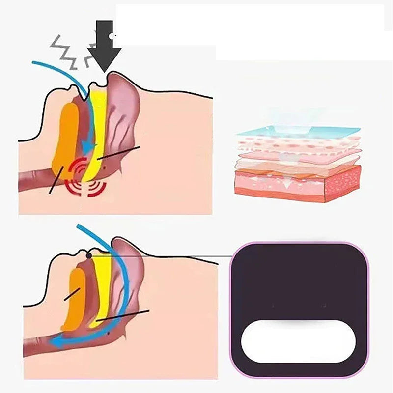 SilentSleep Anti-Snore Strips
